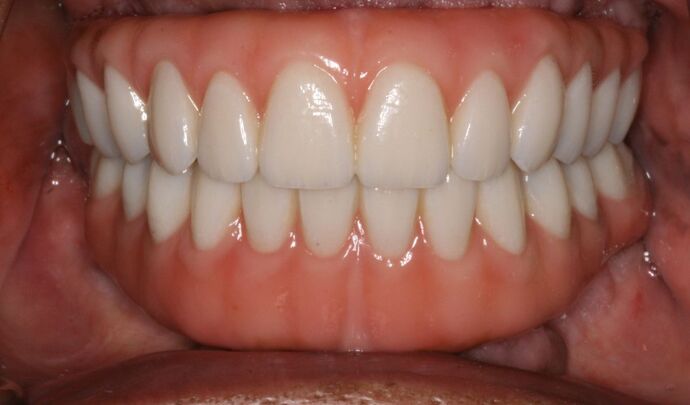 All-on-4/ Full Mouth Dental Implants / Teeth in a Day: Case 17- Upper and Lower All-on-4 Bridges - After