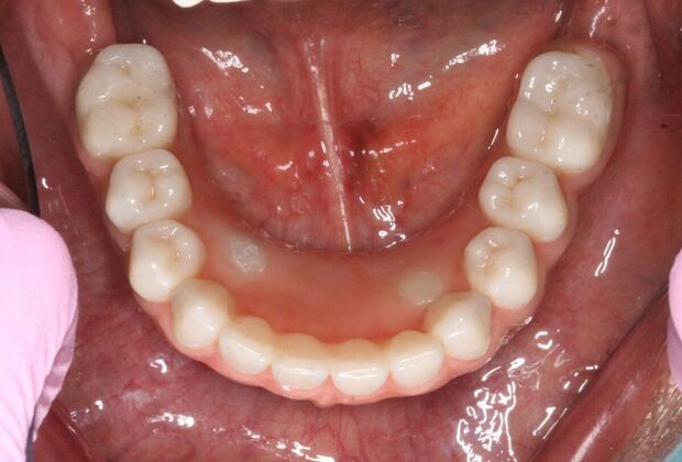 All-on-4/ Full Mouth Dental Implants / Teeth in a Day: Case 17- Upper and Lower All-on-4 Bridges - After