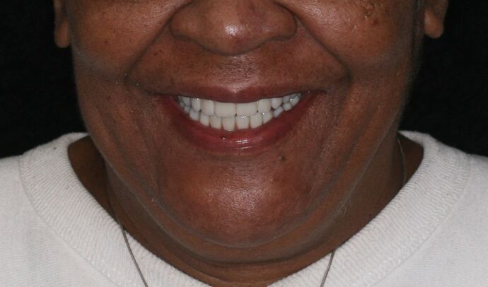 All-on-4/ Full Mouth Dental Implants / Teeth in a Day: Case 17- Upper and Lower All-on-4 Bridges - After