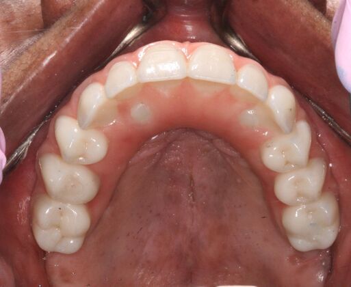 All-on-4/ Full Mouth Dental Implants / Teeth in a Day: Case 17- Upper and Lower All-on-4 Bridges - After