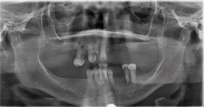 All-on-4/ Full Mouth Dental Implants / Teeth in a Day: Case 17- Upper and Lower All-on-4 Bridges - Before