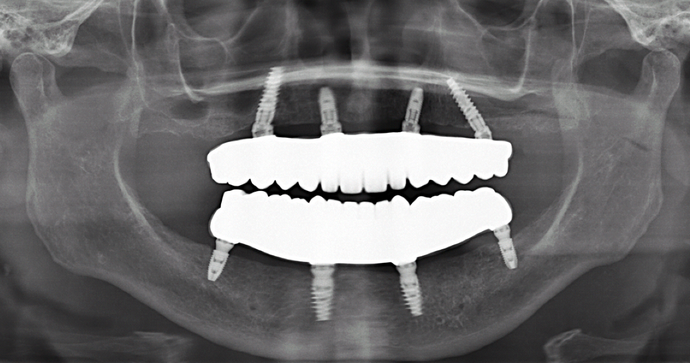 All-on-4/ Full Mouth Dental Implants / Teeth in a Day: Case 17- Upper and Lower All-on-4 Bridges - After