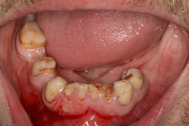 All-on-4/ Full Mouth Dental Implants / Teeth in a Day: Case 18- Upper crowns and Lower All-on-4 Bridge - Before