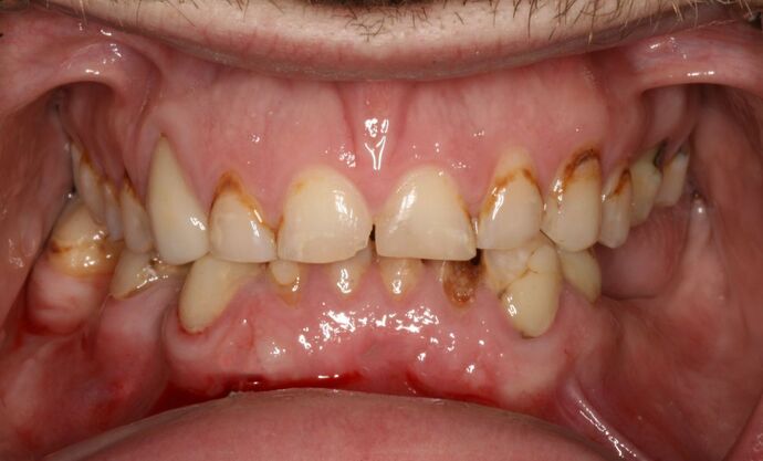 All-on-4/ Full Mouth Dental Implants / Teeth in a Day: Case 18- Upper crowns and Lower All-on-4 Bridge - Before