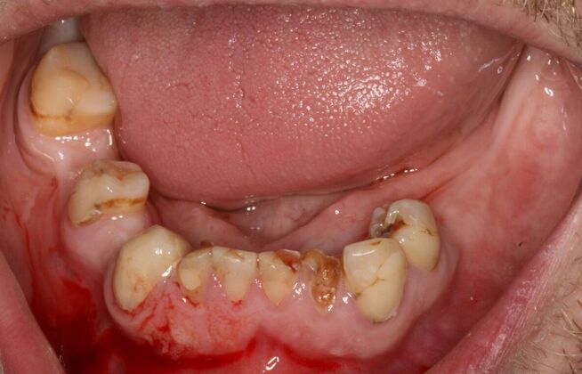 All-on-4/ Full Mouth Dental Implants / Teeth in a Day: Case 18- Upper crowns and Lower All-on-4 Bridge - Before