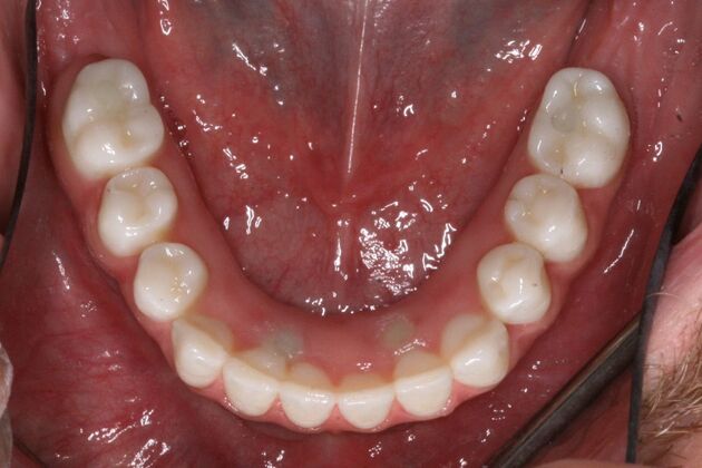 All-on-4/ Full Mouth Dental Implants / Teeth in a Day: Case 18- Upper crowns and Lower All-on-4 Bridge - After