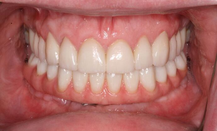 All-on-4/ Full Mouth Dental Implants / Teeth in a Day: Case 18- Upper crowns and Lower All-on-4 Bridge - Before