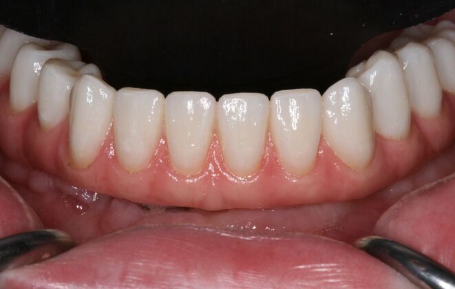 All-on-4/ Full Mouth Dental Implants / Teeth in a Day: Case 18- Upper crowns and Lower All-on-4 Bridge - After