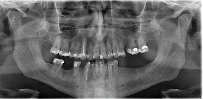 All-on-4/ Full Mouth Dental Implants / Teeth in a Day: Case 18- Upper crowns and Lower All-on-4 Bridge - Before