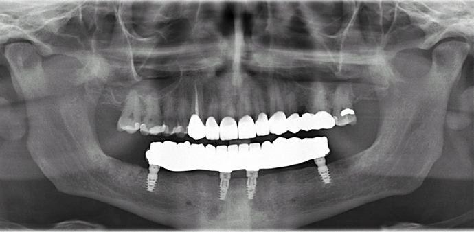 All-on-4/ Full Mouth Dental Implants / Teeth in a Day: Case 18- Upper crowns and Lower All-on-4 Bridge - After
