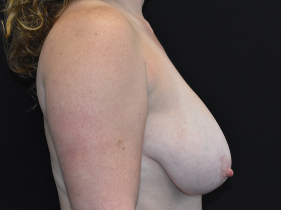 Breast Reduction: Case 5 - Before