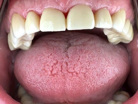 Dental Crowns: Case 2 - After