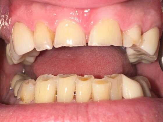 Dental Crowns: Case 2 - Before