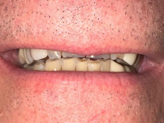 Dental Crowns Case 2 - Before