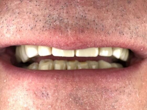 Dental Crowns Case 2 - After