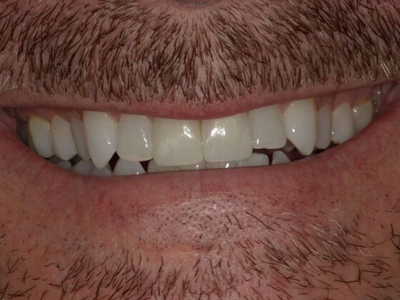 Dental Crowns Case 4 - After