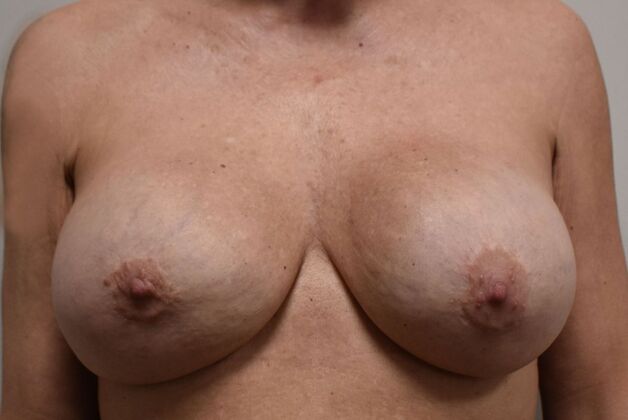 Breast Revision: Case 227 - After