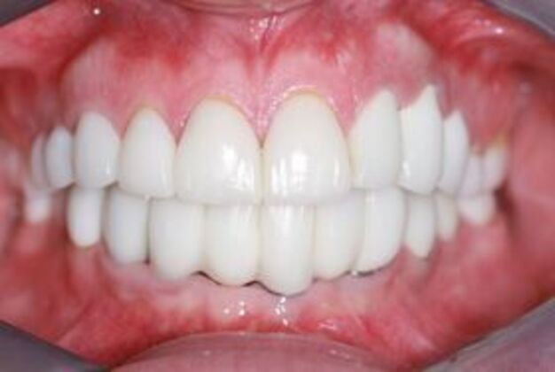 Special Implant Reconstruction Miracle at 7424-Ridge Blvd Bay Ridge Brooklyn - After