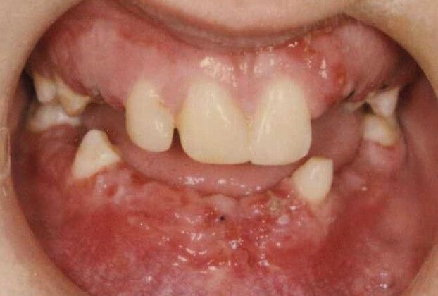 Special Implant Reconstruction Miracle at 7424-Ridge Blvd Bay Ridge Brooklyn - Before