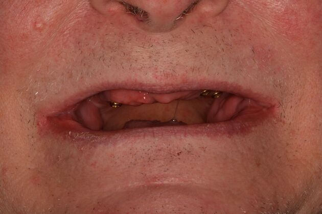 All-on-4/ Full Mouth Dental Implants / Teeth in a Day: Case 19- Upgrading from Failing Snap on Dentures to Permanent Upper and Lower All-on-4 Bridges - Before