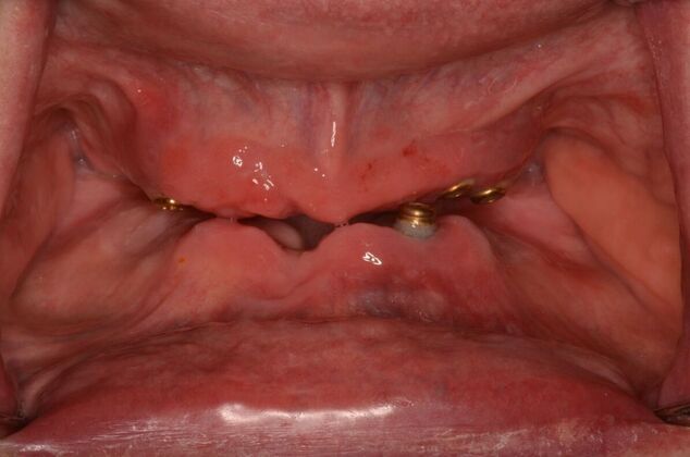All-on-4/ Full Mouth Dental Implants / Teeth in a Day: Case 19- Upgrading from Failing Snap on Dentures to Permanent Upper and Lower All-on-4 Bridges - Before