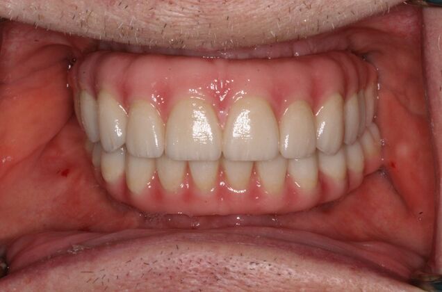 All-on-4/ Full Mouth Dental Implants / Teeth in a Day Case 19- Upgrading from Failing Snap on Dentures to Permanent Upper and Lower All-on-4 Bridges - After