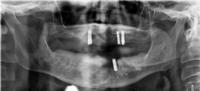 All-on-4/ Full Mouth Dental Implants / Teeth in a Day: Case 19- Upgrading from Failing Snap on Dentures to Permanent Upper and Lower All-on-4 Bridges - Before