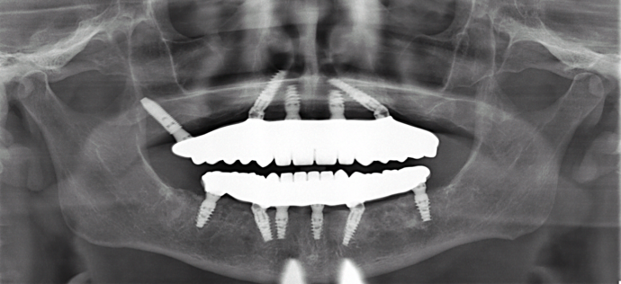 All-on-4/ Full Mouth Dental Implants / Teeth in a Day: Case 19- Upgrading from Failing Snap on Dentures to Permanent Upper and Lower All-on-4 Bridges - After
