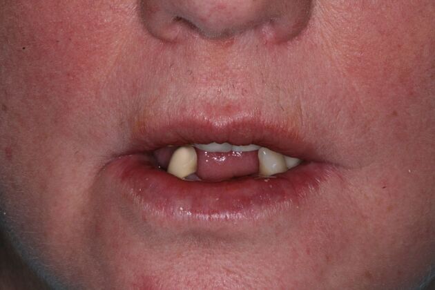 All-on-4/ Full Mouth Dental Implants / Teeth in a Day: Case 20-Gummy smile and failing teeth treatment with Upper and Lower All-on-4 Bridges - Before