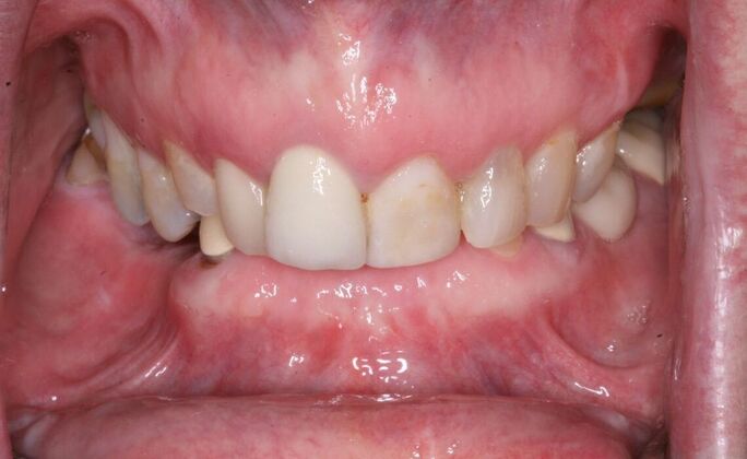 All-on-4/ Full Mouth Dental Implants / Teeth in a Day: Case 20-Gummy smile and failing teeth treatment with Upper and Lower All-on-4 Bridges - Before