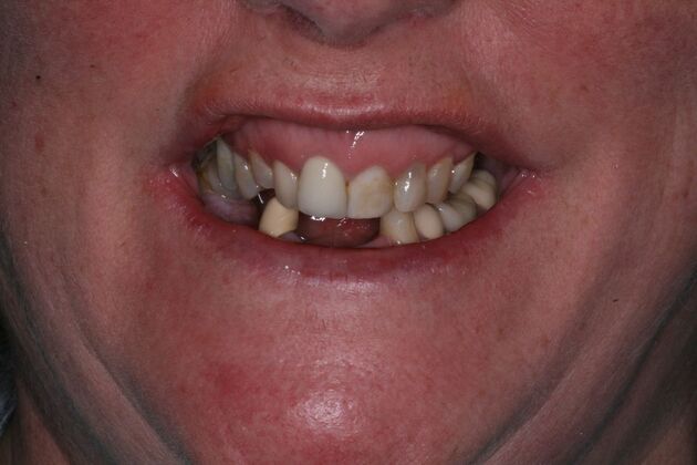 All-on-4/ Full Mouth Dental Implants / Teeth in a Day: Case 20-Gummy smile and failing teeth treatment with Upper and Lower All-on-4 Bridges - Before