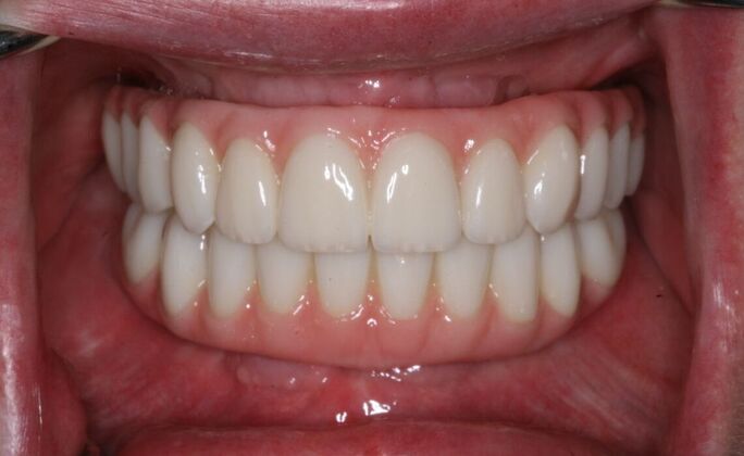 All-on-4/ Full Mouth Dental Implants / Teeth in a Day: Case 20-Gummy smile and failing teeth treatment with Upper and Lower All-on-4 Bridges - After