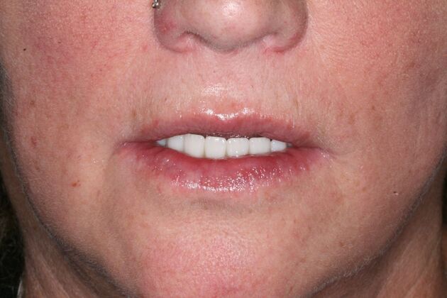 All-on-4/ Full Mouth Dental Implants / Teeth in a Day: Case 20-Gummy smile and failing teeth treatment with Upper and Lower All-on-4 Bridges - After