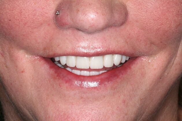 All-on-4/ Full Mouth Dental Implants / Teeth in a Day: Case 20-Gummy smile and failing teeth treatment with Upper and Lower All-on-4 Bridges - After