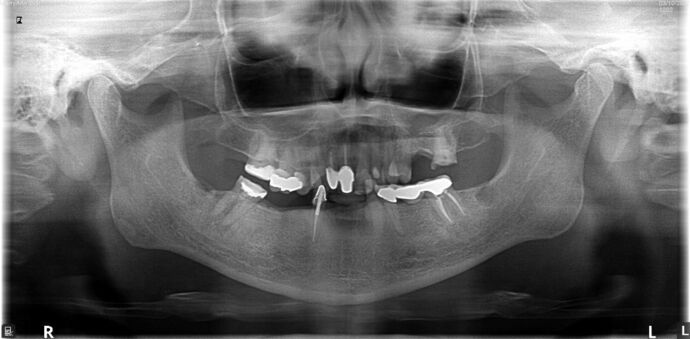 All-on-4/ Full Mouth Dental Implants / Teeth in a Day: Case 20-Gummy smile and failing teeth treatment with Upper and Lower All-on-4 Bridges - Before