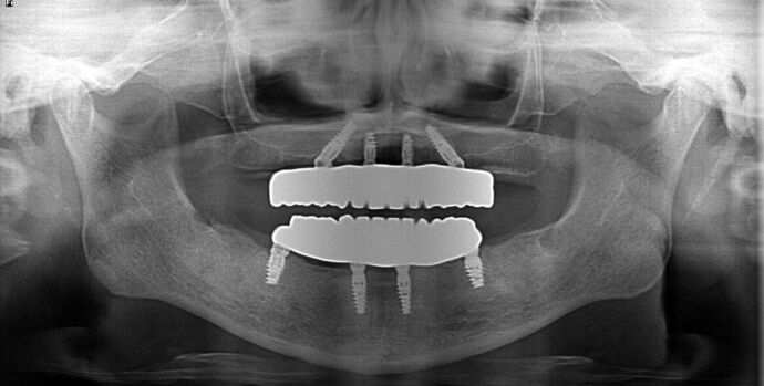 All-on-4/ Full Mouth Dental Implants / Teeth in a Day: Case 20-Gummy smile and failing teeth treatment with Upper and Lower All-on-4 Bridges - After