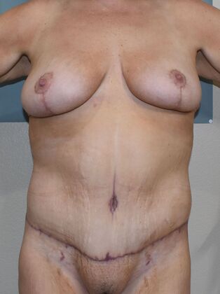 Massive Weight Loss : Case 134 - After