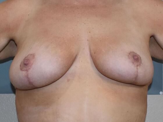 Breast Lift (Mastopexy) Case 184 - After