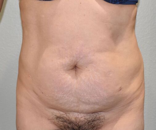Tummy Tuck (Abdominoplasty): Case 441 - Before