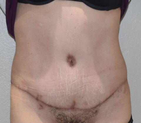 Tummy Tuck (Abdominoplasty): Case 441 - After