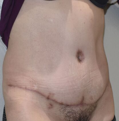 Tummy Tuck (Abdominoplasty): Case 441 - After