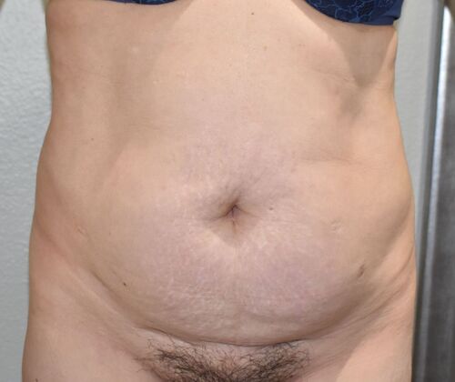 Tummy Tuck (Abdominoplasty): Case 441 - Before