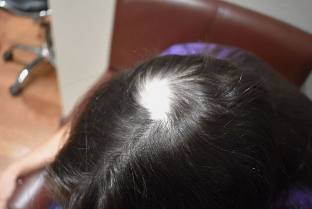 Hair Transplantation Case 4 - Before