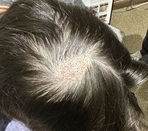 Hair Transplantation Case 4 - After