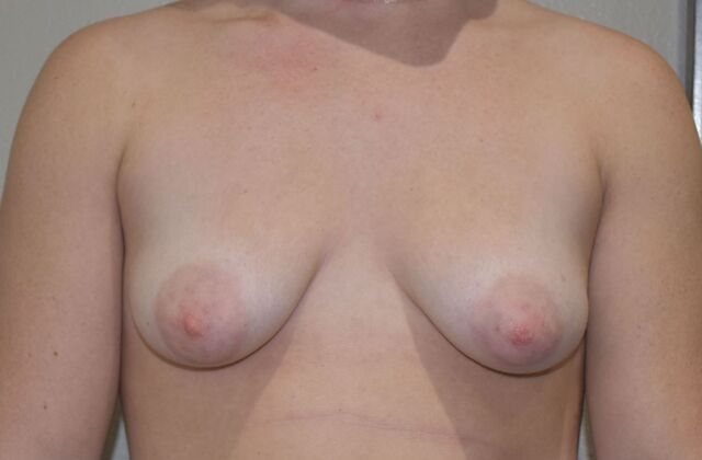 Breast Augmentation w/ Lift Case 511 - Before