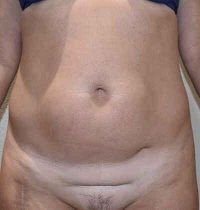 Tummy Tuck (Abdominoplasty): Case 442 - Before