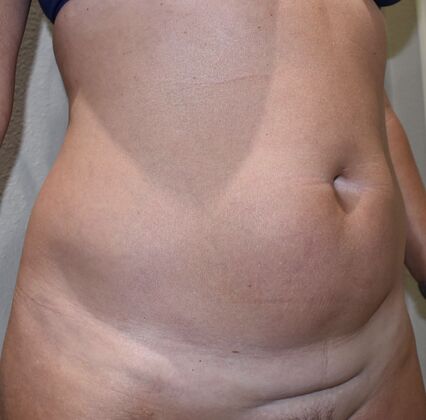 Tummy Tuck (Abdominoplasty): Case 442 - Before