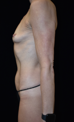 Mommy Makeover: Case 4 - Before