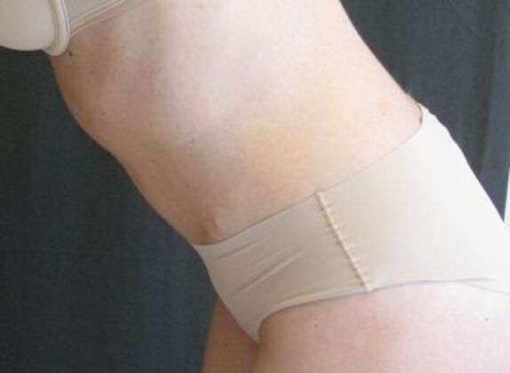 Abdominoplasty: Case 11 - After