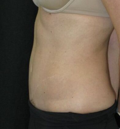 Abdominoplasty: Case 11 - After